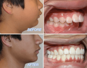 Severe Overbite Corrected