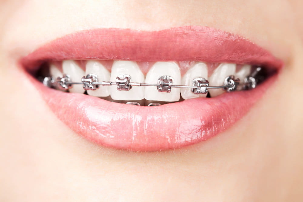 braces before after