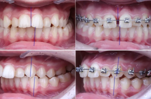 Crossbite Fixed