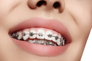 Underbite Transformation